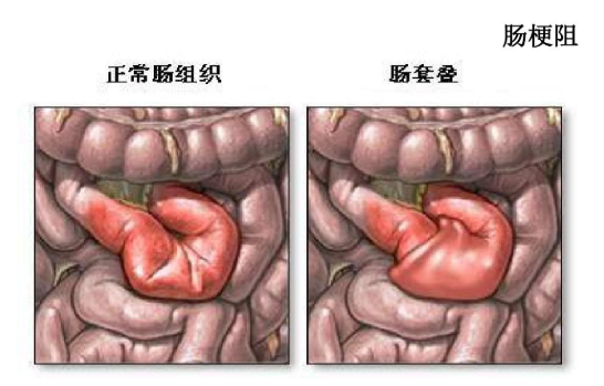 肠梗阻的症状及治疗